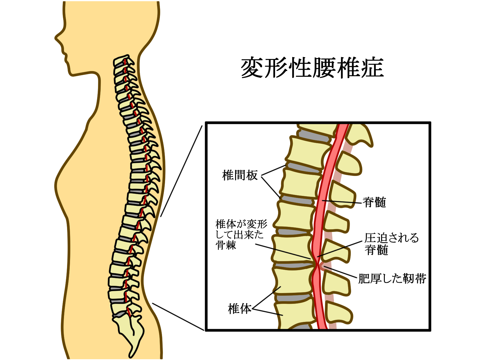脊柱側弯症の原因は何ですか?
